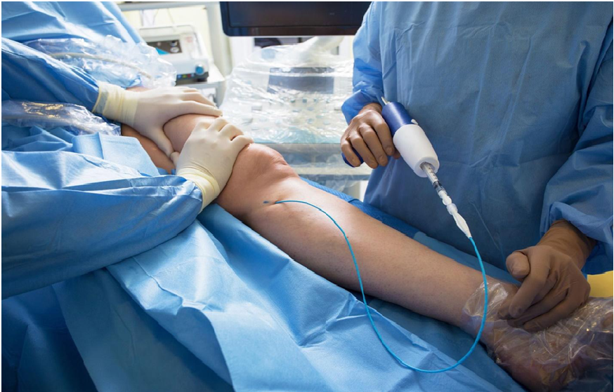 Endovascular Device Supplier